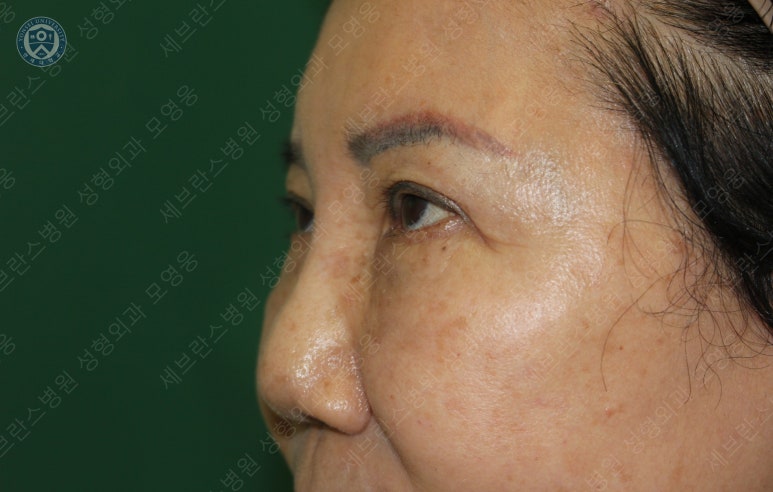 71세 여성, 이마거상술과 이마축소술 (71/F, Forehead lift and reduction) 관련 이미지 34