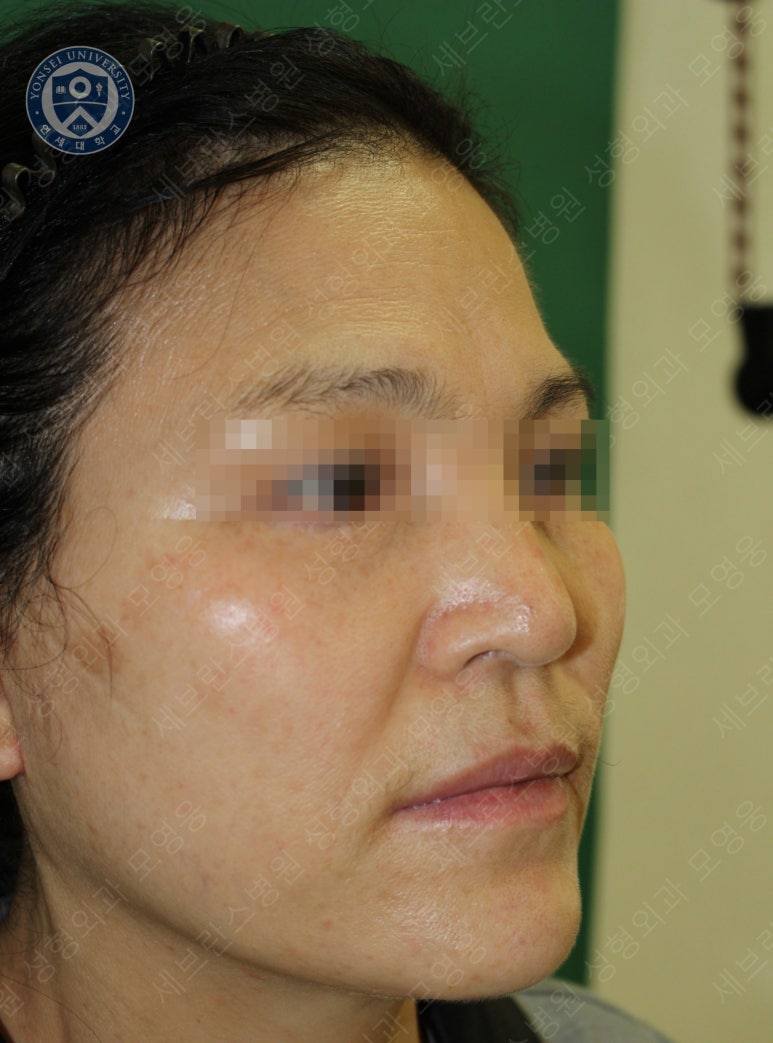 55세 여성, 이중평면 안면거상(55/F, Dual-plane full facelift) 관련 이미지 54
