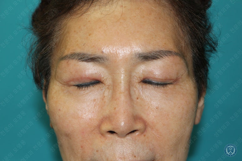64세 여성 상안검성형술+눈매교정 (64/F Upper blepharoplasty with ptosis correction) 관련 이미지 20