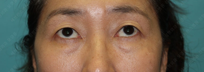 55세 여성, 상안검 및 하안검 성형술 증례 (55/F Upper & lower blepharoplasty) 관련 이미지 4