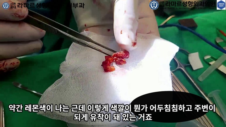 파라핀 필러 입 안 절개로 흉터없이 빼내기! 관련 이미지 50