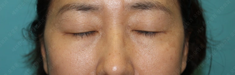 55세 여성, 상안검 및 하안검 성형술 증례 (55/F Upper & lower blepharoplasty) 관련 이미지 3