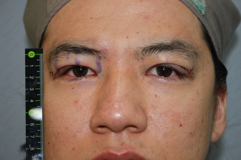 27세 남성 무쌍(속쌍)눈매교정 (27/M Ptosis correction with double lid plasty) 관련 이미지 15