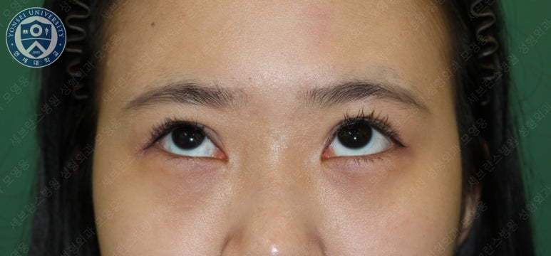 17세 여성, 비절개 눈매교정 및 앞트임 재수술 (17/F NI ptosis correction & Med. epicanthoplasty revision) 증례 관련 이미지 4