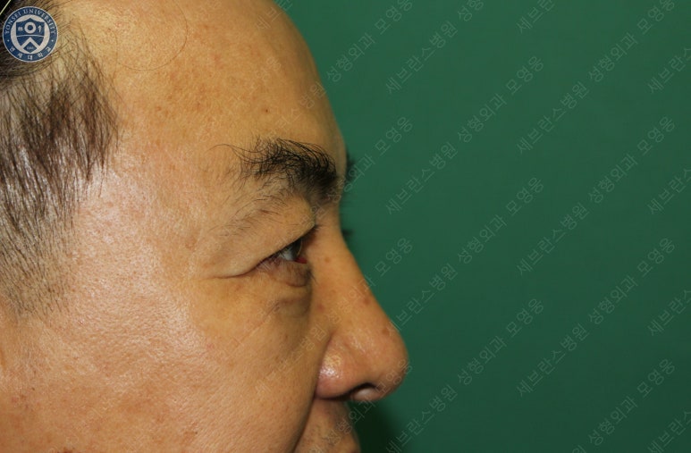 68세 남성, 하안검 성형술 및 안검외반 교정 증례(68/M Lower blepharoplasty & Ectropion correction with triamcinolone) 관련 이미지 12