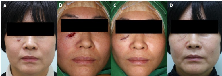 Medicine - Comparison of the recurrence rate of 3 treatmentmodalities for BD in an aging city 관련 이미지 8