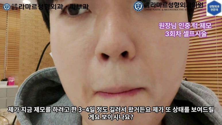 [성형외과 전문의의 셀프시술 제8편] 인중, 아래턱 제모 4회차 결과 공개! 관련 이미지 38