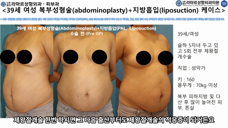 '복부성형술+지방흡입(Abdominoplasty+PAL)' 으로 뱃살 끝장내기! 관련 이미지 25