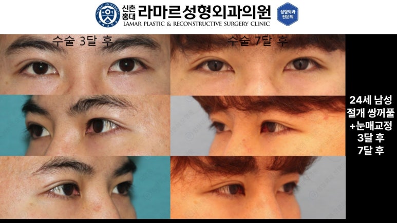 10대~30대 눈 수술 케이스 : 대표원장님 쌍꺼풀 전후 사진 모음 관련 이미지 11