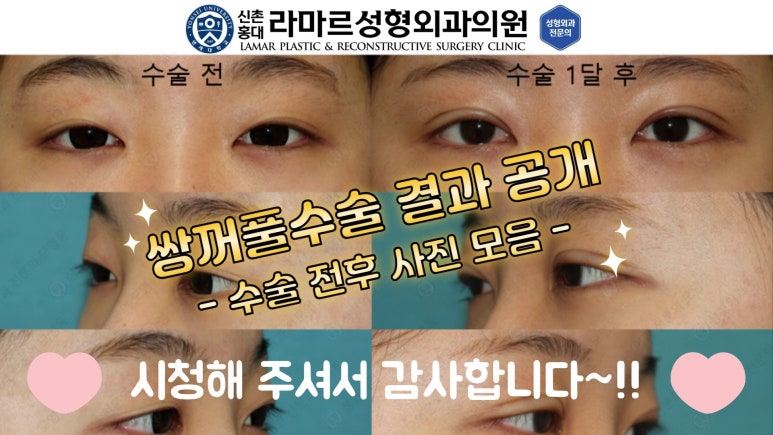10대~30대 눈 수술 케이스 : 대표원장님 쌍꺼풀 전후 사진 모음 관련 이미지 28