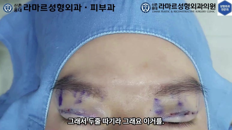 29세 남자, 소시지 쌍꺼풀 두줄따기로 낮추기 (쌍꺼풀 재수술) 관련 이미지 26