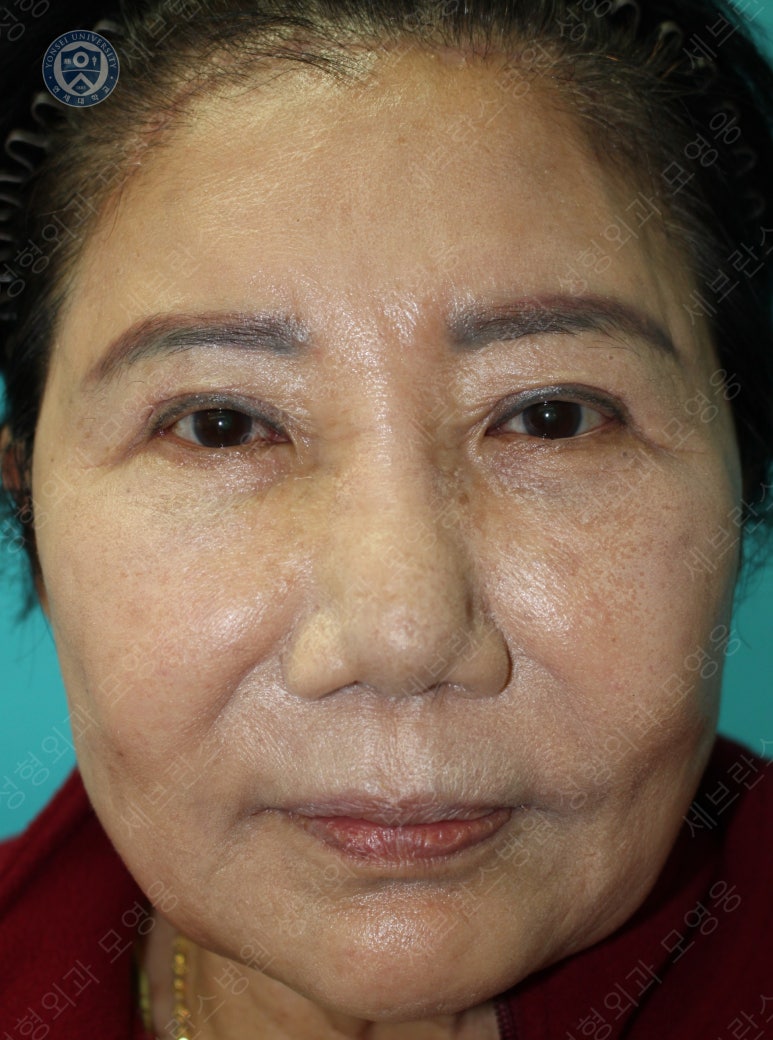 71세 여성, 이마거상술과 이마축소술 (71/F, Forehead lift and reduction) 관련 이미지 40