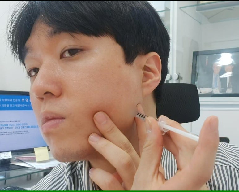 모영웅 대표원장 셀프시술 제6편! 사각턱, 침샘, 미간, 자갈턱 보톡스~! 전체 시술과정 공개합니다 관련 이미지 10