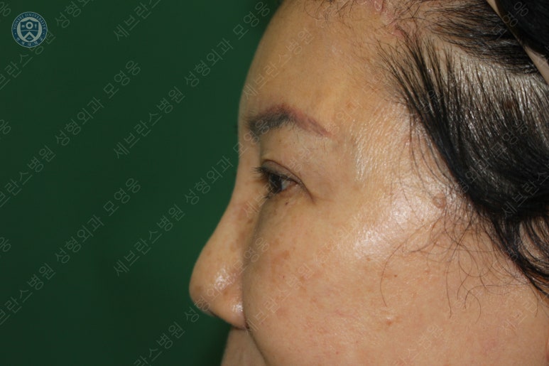 71세 여성, 이마거상술과 이마축소술 (71/F, Forehead lift and reduction) 관련 이미지 33
