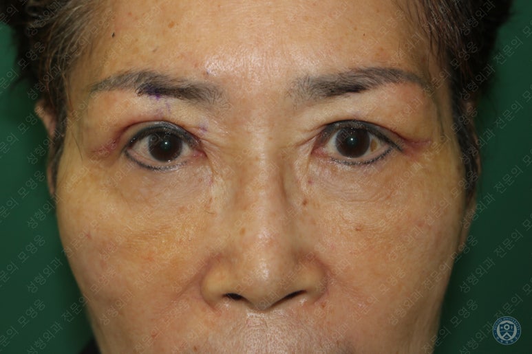 64세 여성 상안검성형술+눈매교정 (64/F Upper blepharoplasty with ptosis correction) 관련 이미지 11