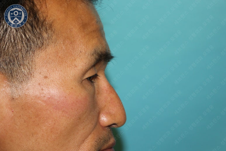 남자눈성형: 무쌍눈매교정 (Blephroptosis correction-levator aponeurosis advancement) 관련 이미지 15