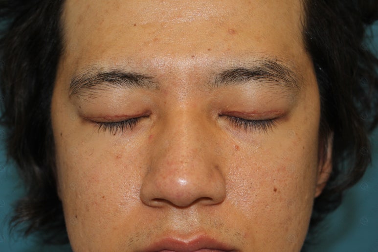 27세 남성 무쌍(속쌍)눈매교정 (27/M Ptosis correction with double lid plasty) 관련 이미지 23