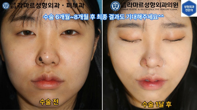 지름 1cm 코 점 제거수술 : 나선피판술(Spiral Flap) 수술전~1달 경과. (Feat. 턱끝필러+사각턱 보톡스) 관련 이미지 13