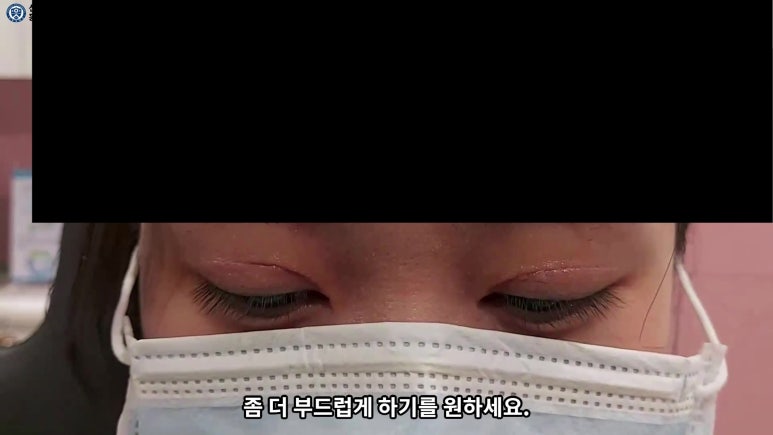 매몰 쌍꺼풀 풀고 절개쌍꺼풀로 바꾸는 쌍꺼풀 재수술!! 관련 이미지 76