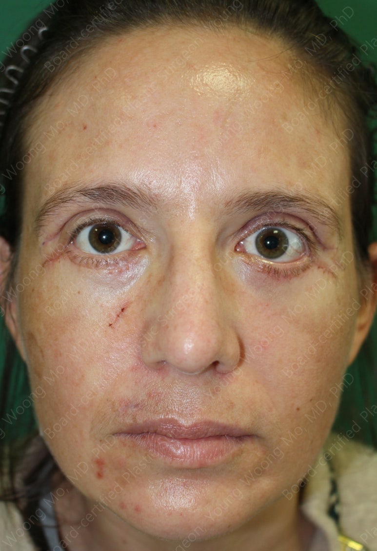 38세 서양 백인 여성, 쌍꺼풀 수술과 눈매교정 및 하안검성형술 (38/F Upper&lower blepharoplasty with levator plication) 관련 이미지 21