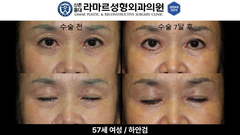 30대~80대 눈 수술 케이스 : 하안검성형술 전후 사진 모음 관련 이미지 42