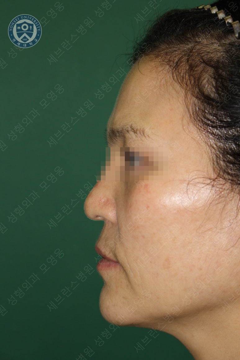 55세 여성, 이중평면 안면거상(55/F, Dual-plane full facelift) 관련 이미지 51