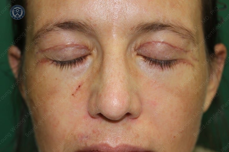 38세 서양 백인 여성, 쌍꺼풀 수술과 눈매교정 및 하안검성형술 (38/F Upper&lower blepharoplasty with levator plication) 관련 이미지 23