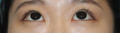 17세 여성, 쌍꺼풀+앞트임(DEO+Medial epicanthoplasty) 관련 이미지 46