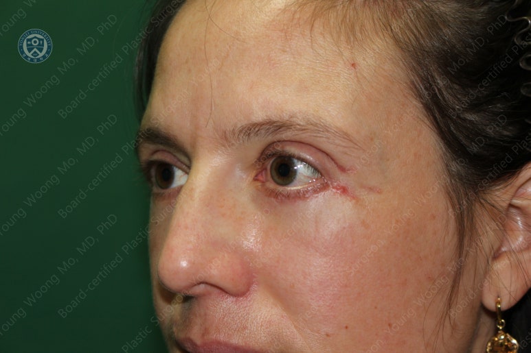 38세 서양 백인 여성, 쌍꺼풀 수술과 눈매교정 및 하안검성형술 (38/F Upper&lower blepharoplasty with levator plication) 관련 이미지 34