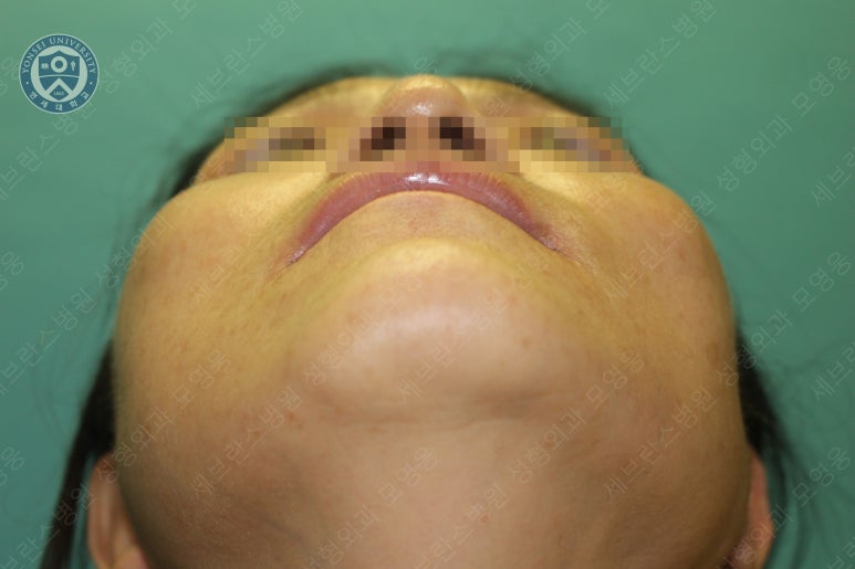 55세 여성, 이중평면 안면거상(55/F, Dual-plane full facelift) 관련 이미지 42