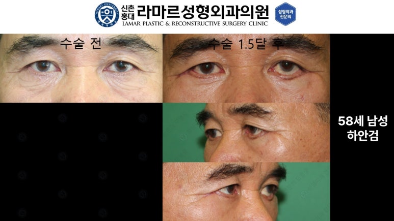 30대~80대 눈 수술 케이스 : 하안검성형술 전후 사진 모음 관련 이미지 43