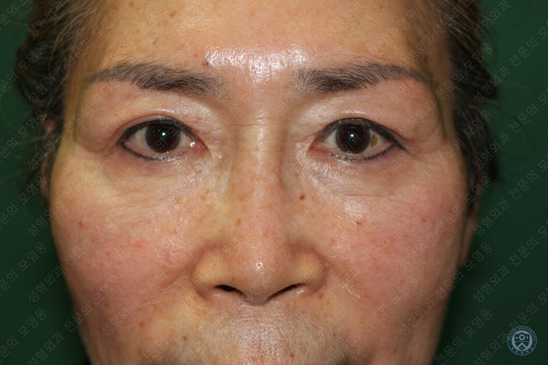 64세 여성 상안검성형술+눈매교정 (64/F Upper blepharoplasty with ptosis correction) 관련 이미지 35