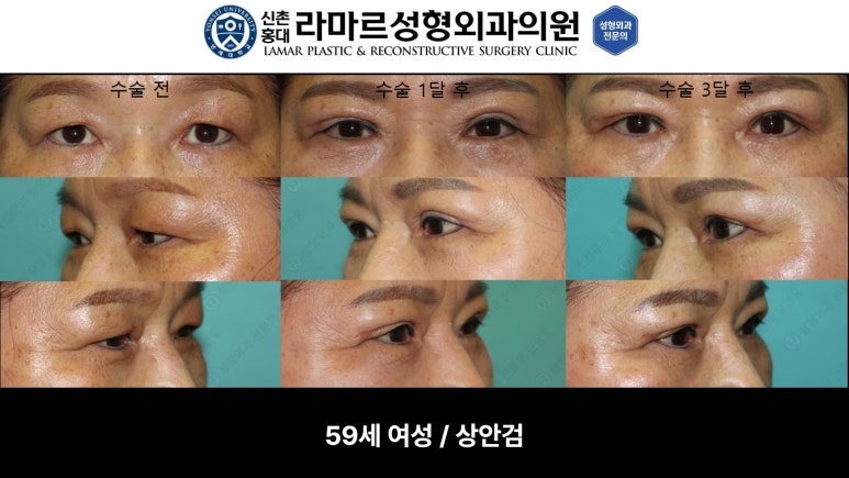 40대~80대 눈 수술 케이스 : 상안검성형술 전후 사진 모음 관련 이미지 16
