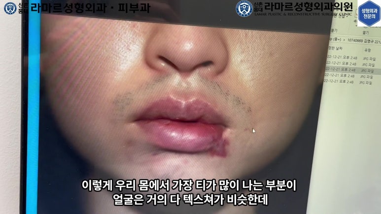 개에 물려 입술 1/3이 뜯긴 19세 남자분 치료 및 흉터 성형수술& 레이저 후기....! 관련 이미지 29