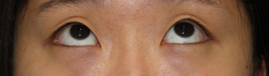 17세 여성, 쌍꺼풀+앞트임(DEO+Medial epicanthoplasty) 관련 이미지 11