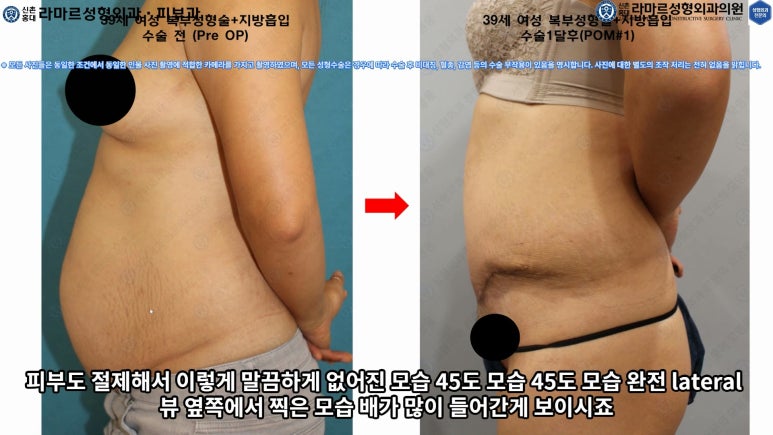 '복부성형술+지방흡입(Abdominoplasty+PAL)' 으로 뱃살 끝장내기! 관련 이미지 55
