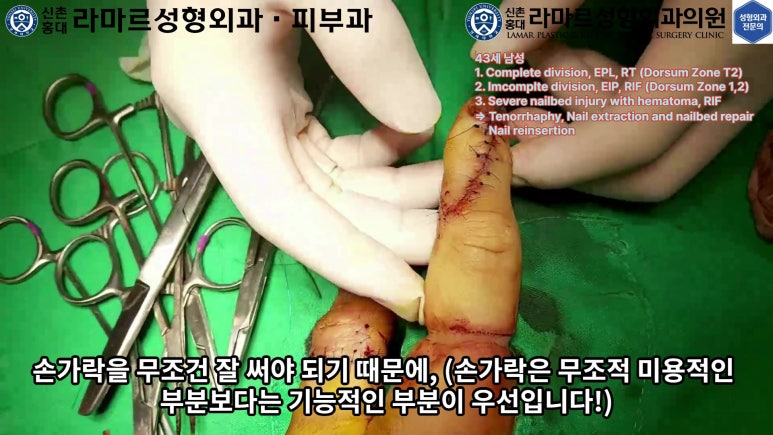 손가락 힘줄 손상 및 열상, 손톱 바닥 열상 처치 (Extensor tendon repair and nailbed injury treatment) 관련 이미지 34
