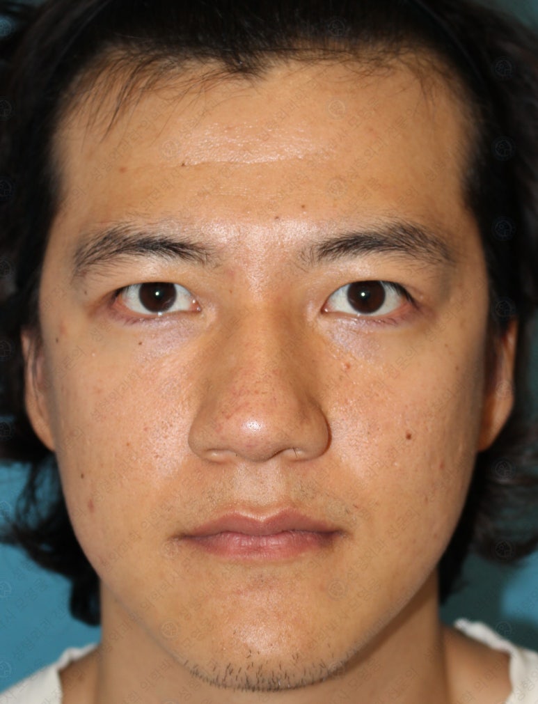 27세 남성 무쌍(속쌍)눈매교정 (27/M Ptosis correction with double lid plasty) 관련 이미지 29