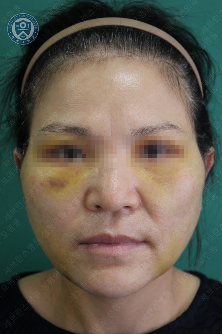 55세 여성, 이중평면 안면거상(55/F, Dual-plane full facelift) 관련 이미지 17