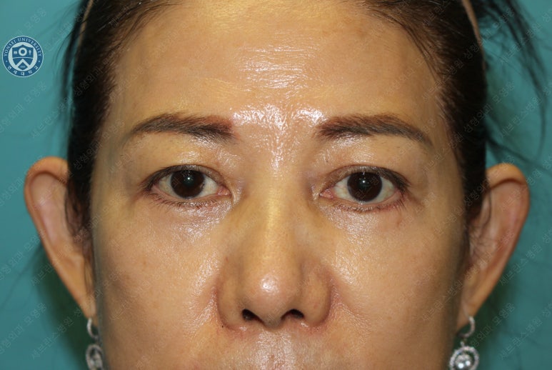 59세 여성, 그레이브스 안병증이 있는 돌출눈 중년 여성 하안검 성형술 (Lower blepharoplasty in Graves 관련 이미지 26