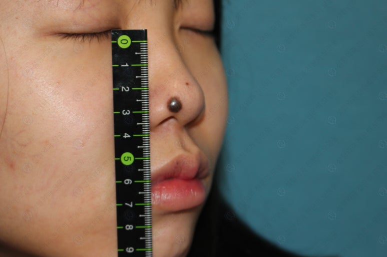 지름 1cm 코 점 제거수술 : 나선피판술(Spiral Flap) 수술전~1달 경과. (Feat. 턱끝필러+사각턱 보톡스) 관련 이미지 43