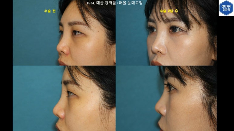 30대 여성 "쌍꺼풀+눈매교정" 상담, 디자인, 수술 전체 과정, 결과, 경과 모두 공개합니다. 관련 이미지 92
