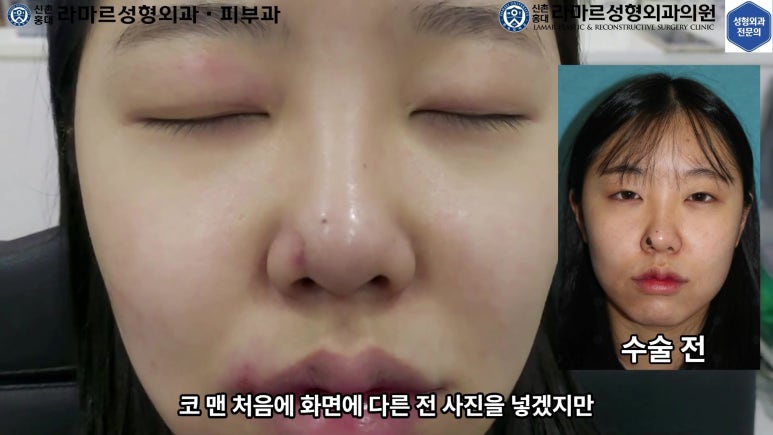 21세 여성 코 지름 1cm 점 제거수술 : 나선피판술(Spiral Flap) 수술전~5달 경과. (+쌍꺼풀수술, 코필러) 관련 이미지 18