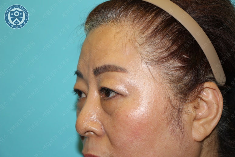 60세 여성, 상안검 및 하안검 성형술 증례 (60/F Upper & lower blepharoplasty) 관련 이미지 6