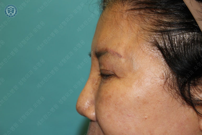71세 여성, 이마거상술과 이마축소술 (71/F, Forehead lift and reduction) 관련 이미지 6