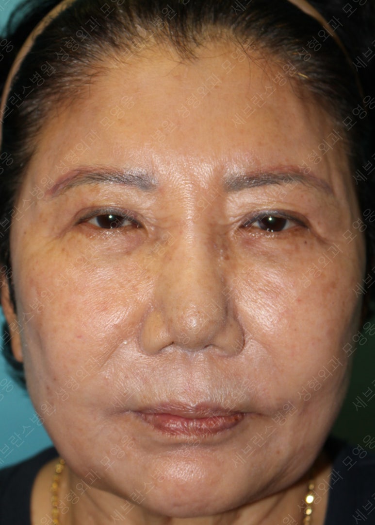 71세 여성, 이마거상술과 이마축소술 (71/F, Forehead lift and reduction) 관련 이미지 3