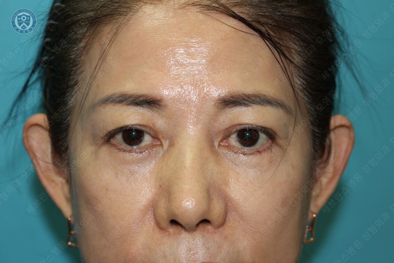 59세 여성, 그레이브스 안병증이 있는 돌출눈 중년 여성 하안검 성형술 (Lower blepharoplasty in Graves 관련 이미지 34