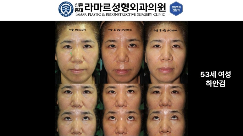 30대~80대 눈 수술 케이스 : 하안검성형술 전후 사진 모음 관련 이미지 33