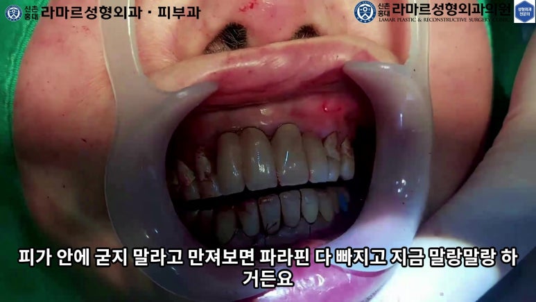 파라핀 필러 입 안 절개로 흉터없이 빼내기! 관련 이미지 83