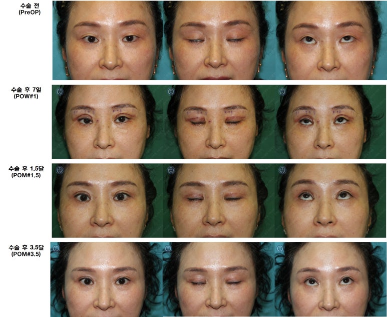 49세 여성, 토안이 있는 중년여성의 상안검성형술 (49/F, Upper blepharoplasty with lagophthalmos correction& LP) 관련 이미지 44